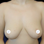 Breast Lift Before & After Patient #2465