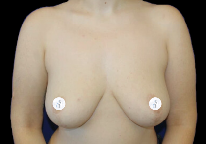 Breast Lift Before & After Patient #2465