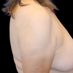Breast Reduction Before & After Patient #2798
