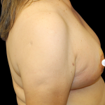 Breast Reduction Before & After Patient #2798