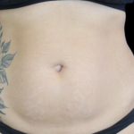 Liposuction Abdomen Before & After Patient #2803