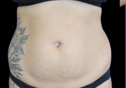 Liposuction Abdomen Before & After Patient #2803