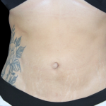 Liposuction Abdomen Before & After Patient #2803