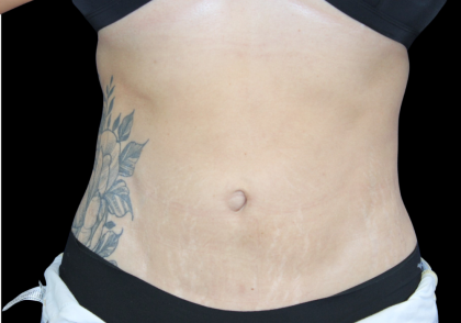 Liposuction Abdomen Before & After Patient #2803