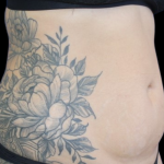 Liposuction Abdomen Before & After Patient #2803