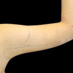 Liposuction to Arms Before & After Patient #2827
