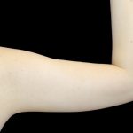 Liposuction to Arms Before & After Patient #2827