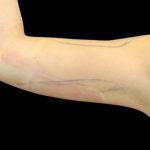 Liposuction to Arms Before & After Patient #2827