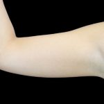 Liposuction to Arms Before & After Patient #2827