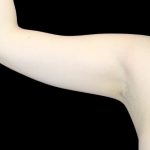Liposuction to Arms Before & After Patient #2836