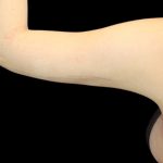 Liposuction to Arms Before & After Patient #2836