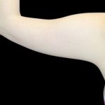 Liposuction to Arms Before & After Patient #2836