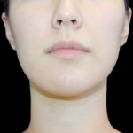 Fat Grafting Neck & Chin Before & After Patient #2902