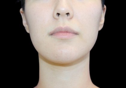 Fat Grafting Neck & Chin Before & After Patient #2902