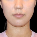 Fat Grafting Neck & Chin Before & After Patient #2902