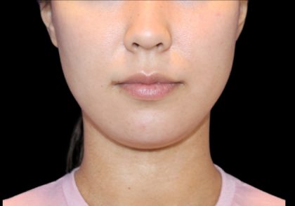 Fat Grafting Neck & Chin Before & After Patient #2902