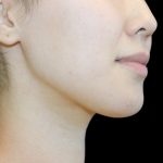 Fat Grafting Neck & Chin Before & After Patient #2902
