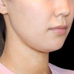 Fat Grafting Neck & Chin Before & After Patient #2902
