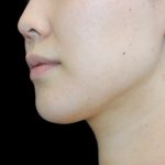 Fat Grafting Neck & Chin Before & After Patient #2902