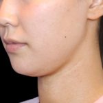Fat Grafting Neck & Chin Before & After Patient #2902