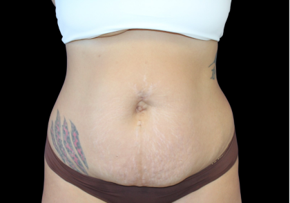 Liposuction Abdomen Before & After Patient #874