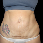 Liposuction Abdomen Before & After Patient #874