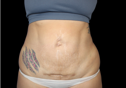 Liposuction Abdomen Before & After Patient #874