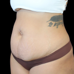 Liposuction Abdomen Before & After Patient #874