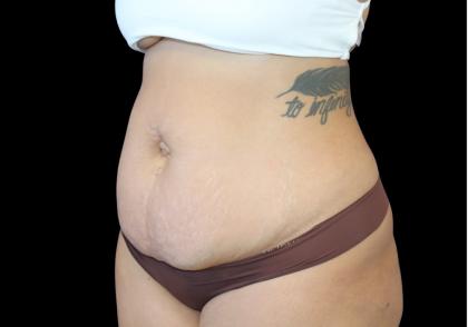 Liposuction Abdomen Before & After Patient #874