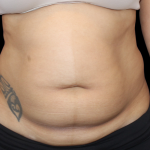 Liposuction Abdomen Before & After Patient #2802