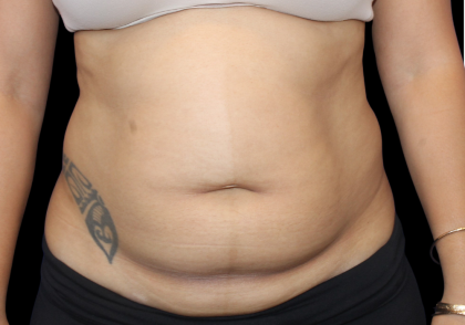 Liposuction Abdomen Before & After Patient #2802