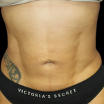 Liposuction Abdomen Before & After Patient #2802