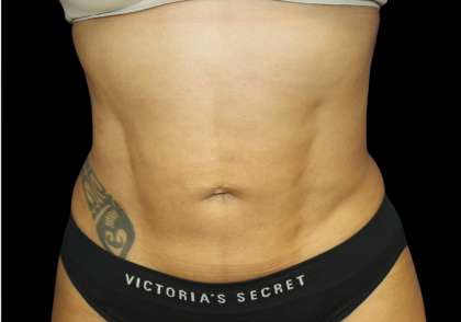 Liposuction Abdomen Before & After Patient #2802
