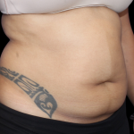 Liposuction Abdomen Before & After Patient #2802