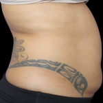 Liposuction Abdomen Before & After Patient #2802