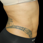 Liposuction Abdomen Before & After Patient #2802