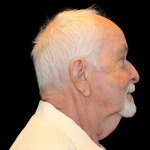 Neck Lift Before & After Patient #2477