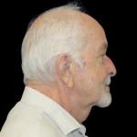 Neck Lift Before & After Patient #2477