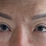 Blepharoplasty Before & After Patient #2496