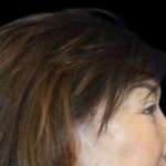 Blepharoplasty Before & After Patient #2496