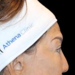 Blepharoplasty Before & After Patient #2496