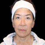 Blepharoplasty Before & After Patient #2496