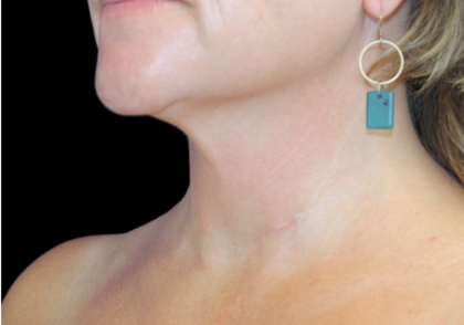Neck Liposuction Before & After Patient #2799