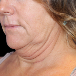 Neck Liposuction Before & After Patient #2799