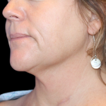 Neck Liposuction Before & After Patient #2799