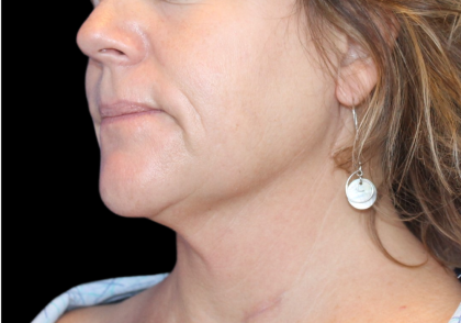 Neck Liposuction Before & After Patient #2799