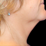 Neck Liposuction Before & After Patient #2799