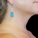 Neck Liposuction Before & After Patient #2799