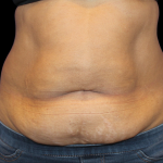 Liposuction Abdomen Before & After Patient #2801