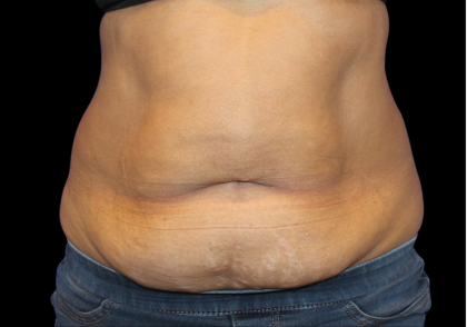 Liposuction Abdomen Before & After Patient #2801